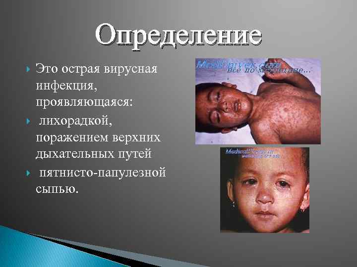 Определение Это острая вирусная инфекция, проявляющаяся: лихорадкой, поражением верхних дыхательных путей пятнисто-папулезной сыпью. 