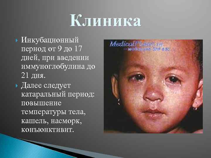 Клиника Инкубационный период от 9 до 17 дней, при введении иммуноглобулина до 21 дня.