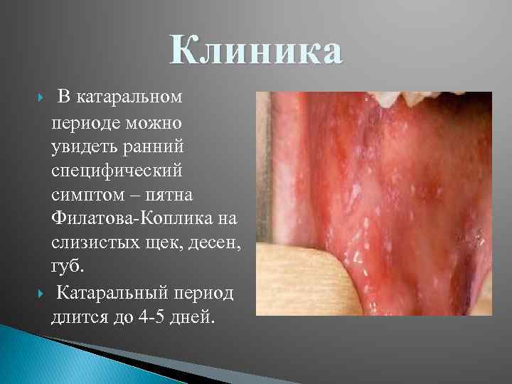 Клиника В катаральном периоде можно увидеть ранний специфический симптом – пятна Филатова-Коплика на слизистых