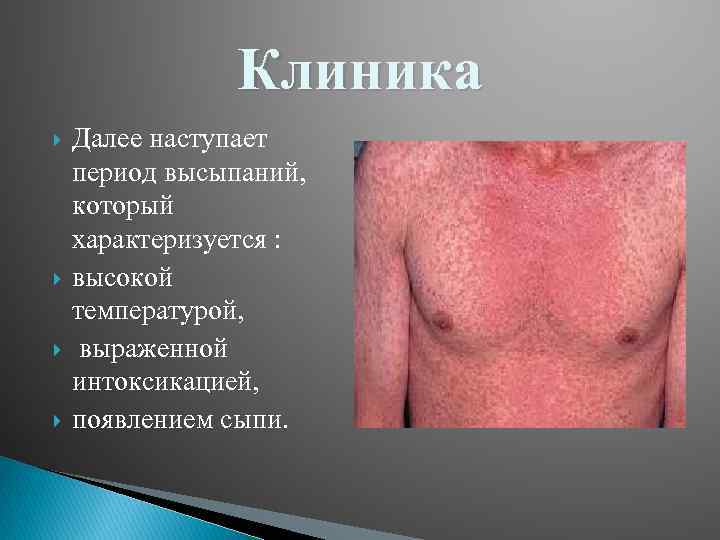 Клиника Далее наступает период высыпаний, который характеризуется : высокой температурой, выраженной интоксикацией, появлением сыпи.
