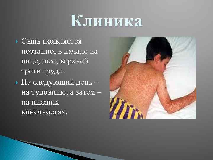 Клиника Сыпь появляется поэтапно, в начале на лице, шее, верхней трети груди. На следующий