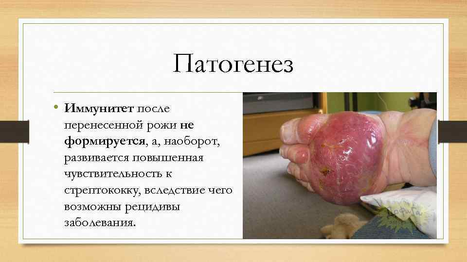 Патогенез • Иммунитет после перенесенной рожи не формируется, а, наоборот, развивается повышенная чувствительность к