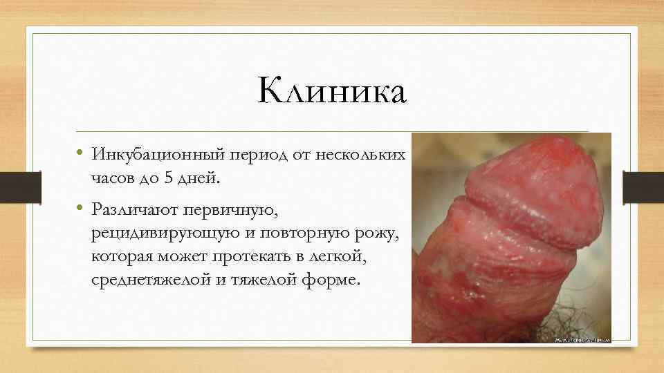 Клиника • Инкубационный период от нескольких часов до 5 дней. • Различают первичную, рецидивирующую