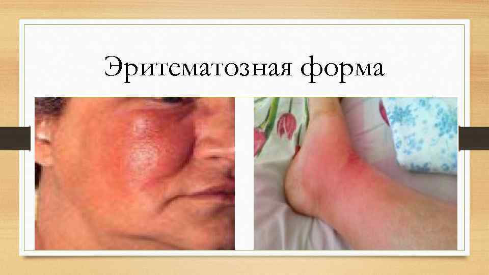 Эритематозная форма 