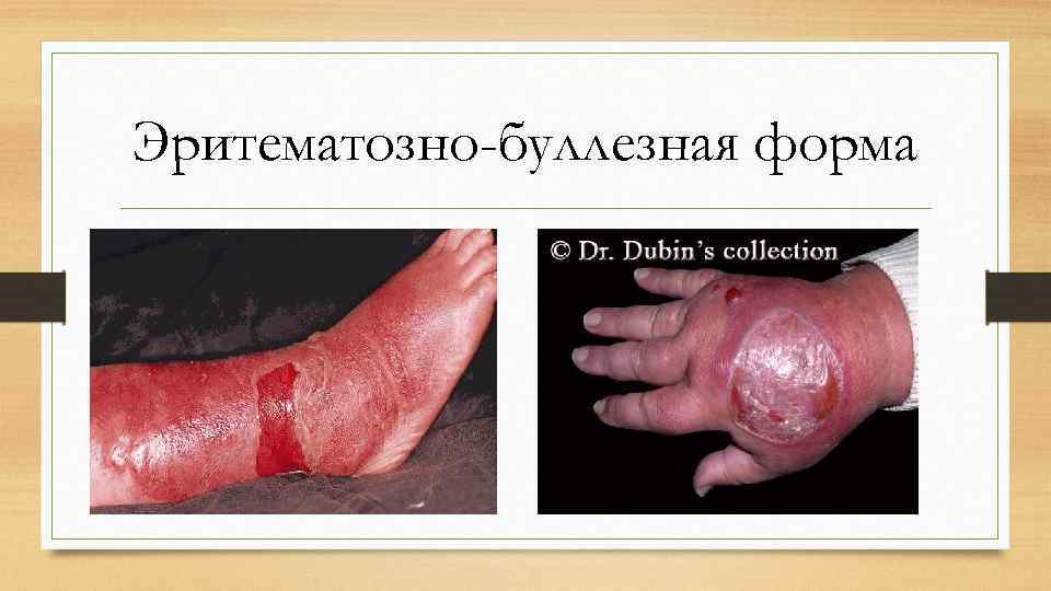 Эритематозно-буллезная форма 
