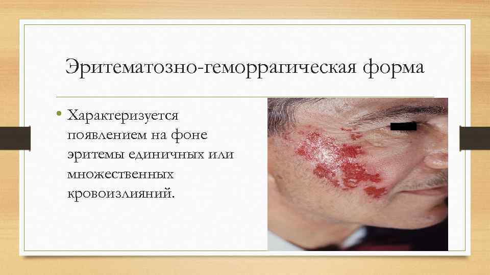 Эритематозно-геморрагическая форма • Характеризуется появлением на фоне эритемы единичных или множественных кровоизлияний. 