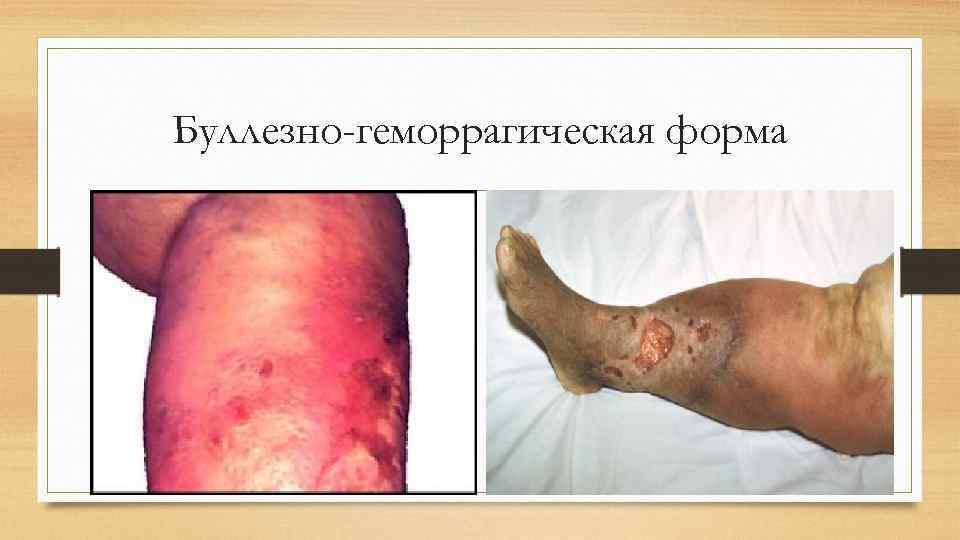 Буллезно-геморрагическая форма 
