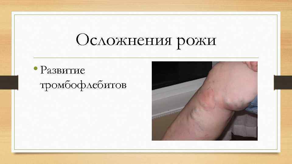 Осложнения рожи • Развитие тромбофлебитов 