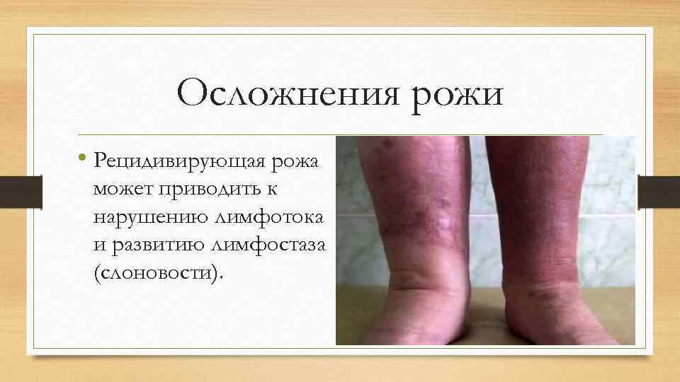 Осложнения рожи • Рецидивирующая рожа может приводить к нарушению лимфотока и развитию лимфостаза (слоновости).
