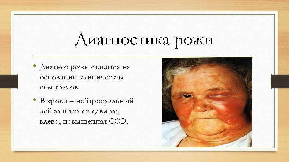 Диагностика рожи • Диагноз рожи ставится на основании клинических симптомов. • В крови –