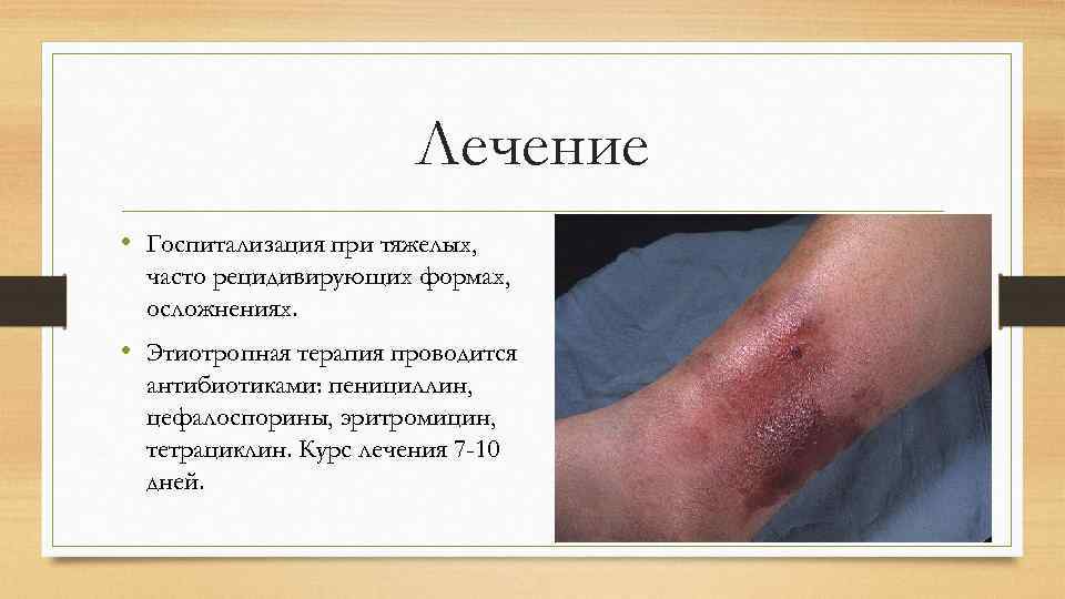 Лечение • Госпитализация при тяжелых, часто рецидивирующих формах, осложнениях. • Этиотропная терапия проводится антибиотиками: