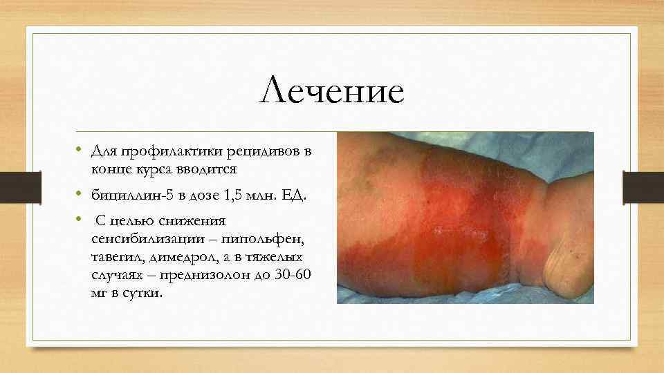 Лечение • Для профилактики рецидивов в конце курса вводится • бициллин-5 в дозе 1,