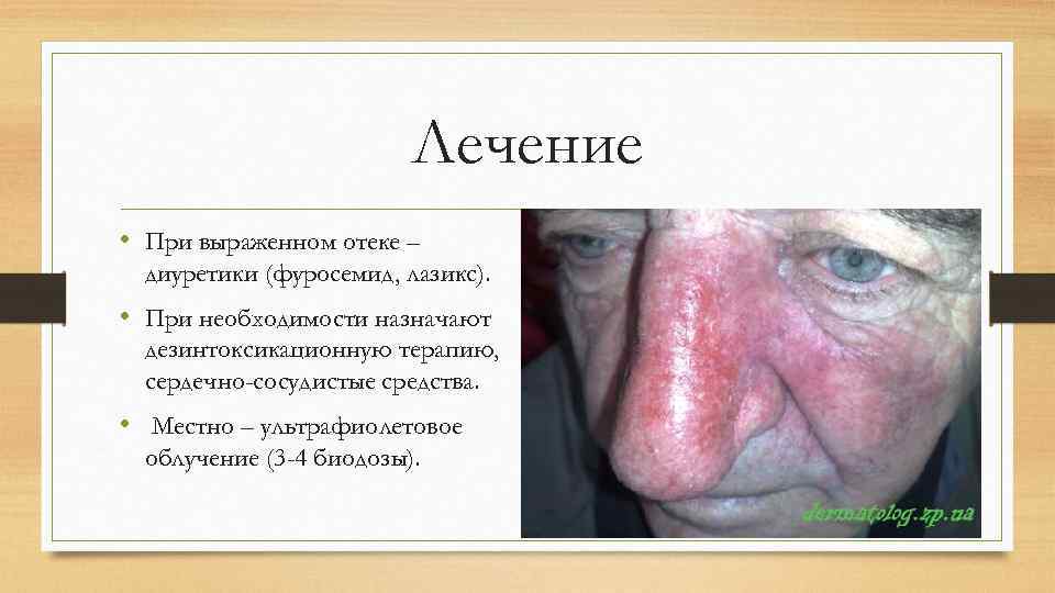 Лечение • При выраженном отеке – диуретики (фуросемид, лазикс). • При необходимости назначают дезинтоксикационную