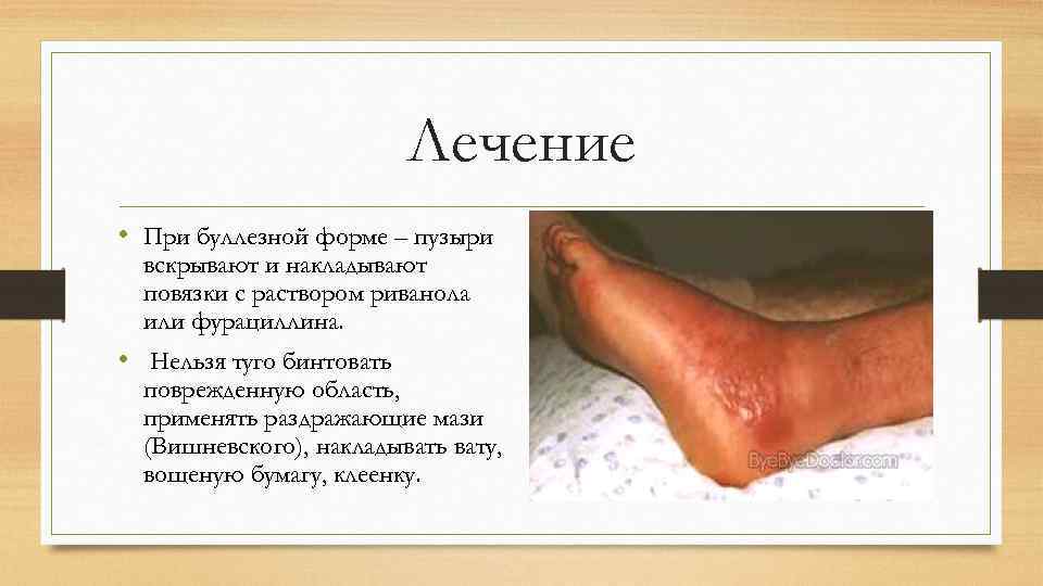 Лечение • При буллезной форме – пузыри вскрывают и накладывают повязки с раствором риванола