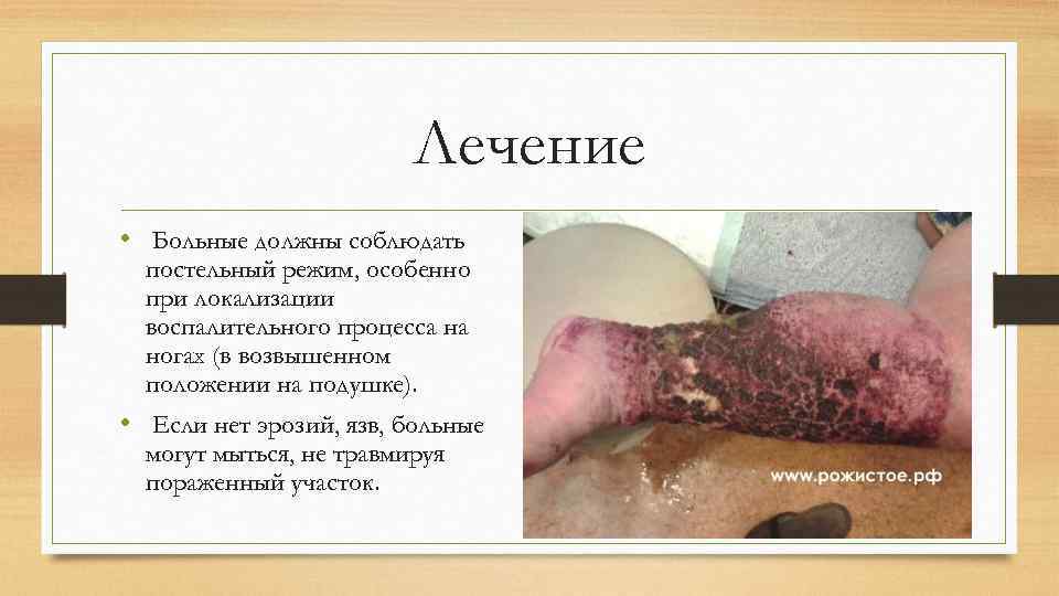 Лечение • Больные должны соблюдать постельный режим, особенно при локализации воспалительного процесса на ногах