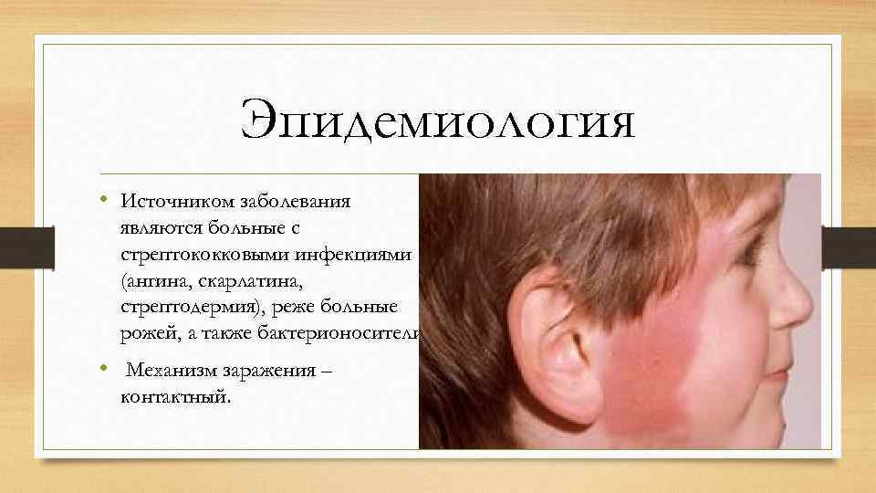 Эпидемиология • Источником заболевания являются больные с стрептококковыми инфекциями (ангина, скарлатина, стрептодермия), реже больные