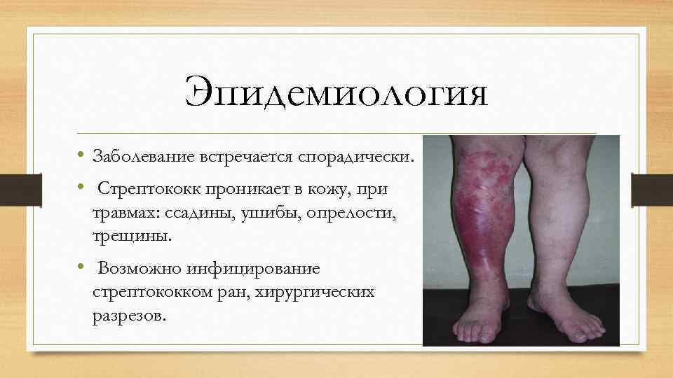 Эпидемиология • Заболевание встречается спорадически. • Стрептококк проникает в кожу, при травмах: ссадины, ушибы,