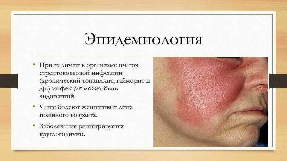 Эпидемиология • При наличии в организме очагов стрептококковой инфекции (хронический тонзиллит, гайморит и др.