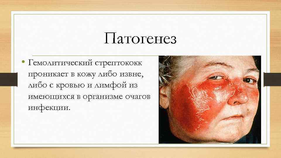 Патогенез • Гемолитический стрептококк проникает в кожу либо извне, либо с кровью и лимфой