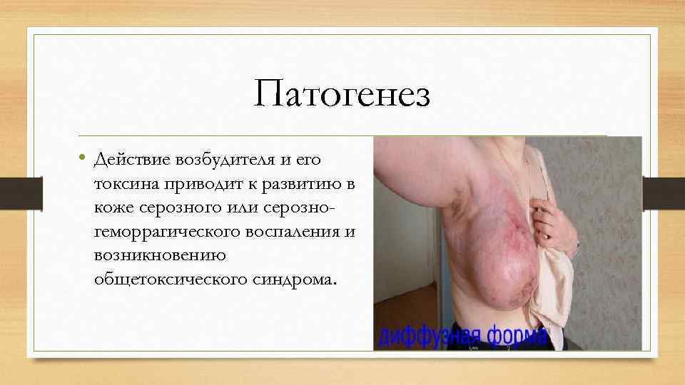 Патогенез • Действие возбудителя и его токсина приводит к развитию в коже серозного или