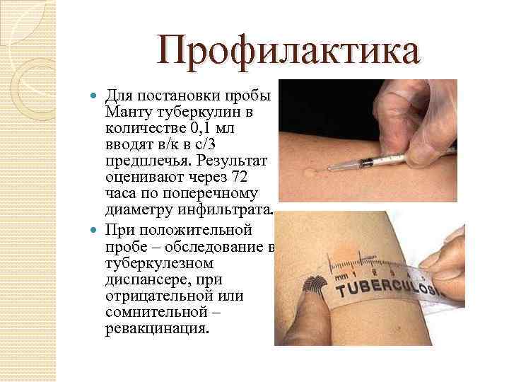 Профилактика Для постановки пробы Манту туберкулин в количестве 0, 1 мл вводят в/к в