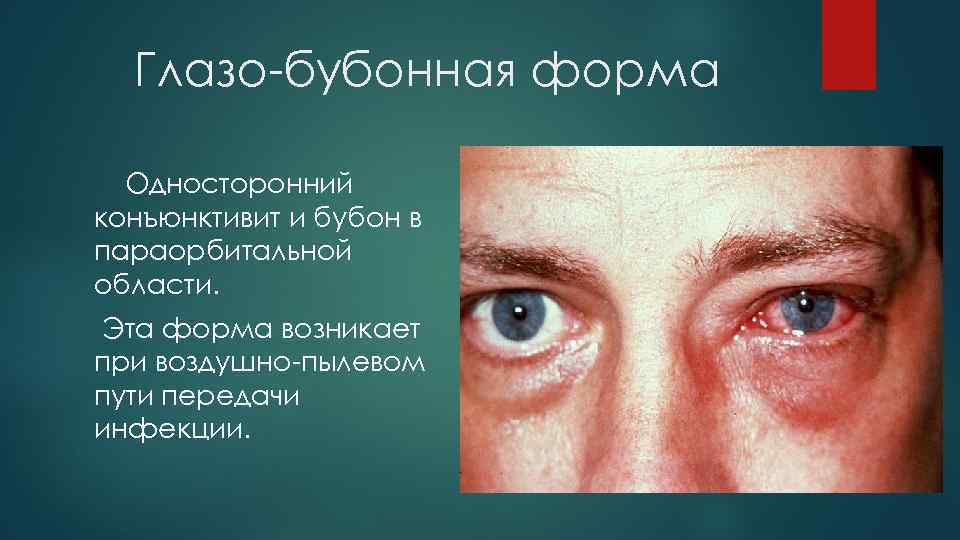 Глазо-бубонная форма Односторонний конъюнктивит и бубон в параорбитальной области. Эта форма возникает при воздушно-пылевом