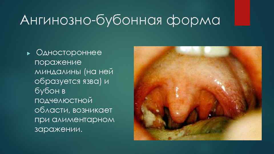 Ангинозно-бубонная форма Одностороннее поражение миндалины (на ней образуется язва) и бубон в подчелюстной области,