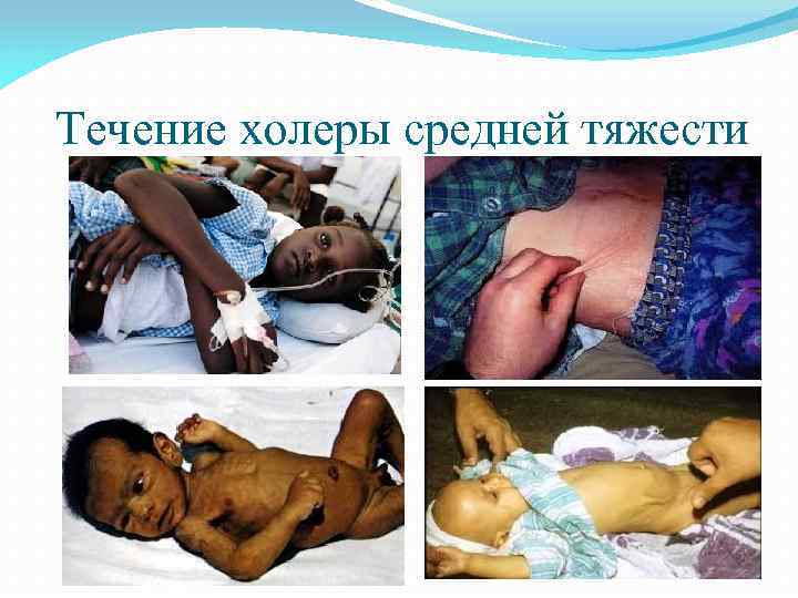 Течение холеры средней тяжести 