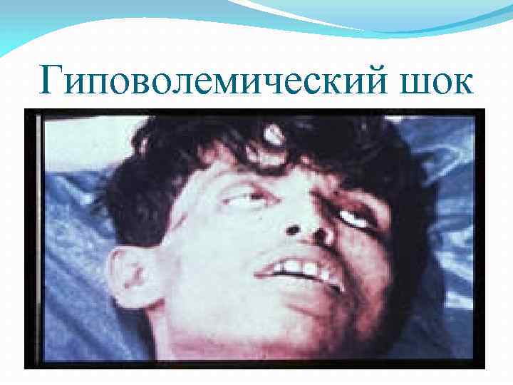 Гиповолемический шок 