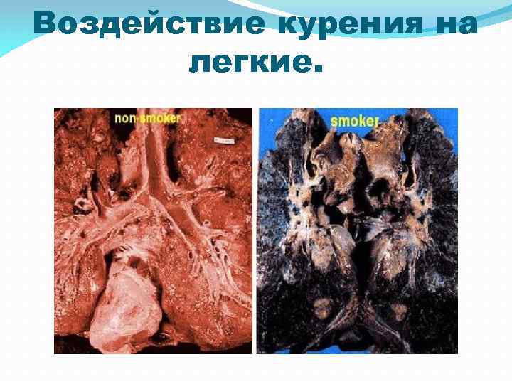 Воздействие курения на легкие. 