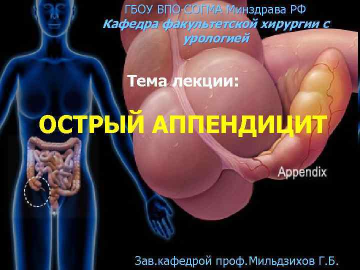 ГБОУ ВПО СОГМА Минздрава РФ Кафедра факультетской хирургии с урологией Тема лекции: ОСТРЫЙ АППЕНДИЦИТ