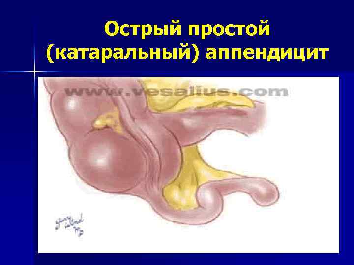 Острый простой (катаральный) аппендицит 