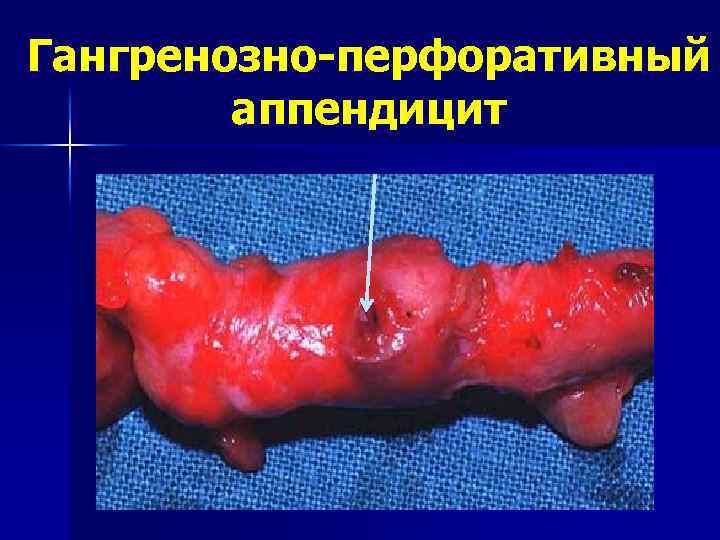 Гангренозно-перфоративный аппендицит 