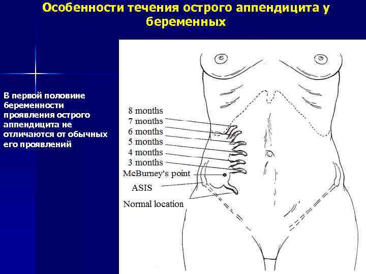 Особенности течения острого аппендицита у беременных В первой половине беременности проявления острого аппендицита не