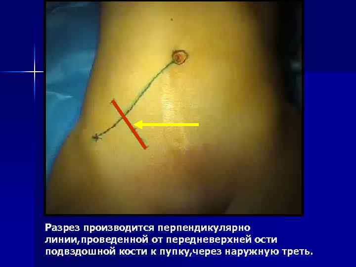 Разрез производится перпендикулярно линии, проведенной от передневерхней ости подвздошной кости к пупку, через наружную