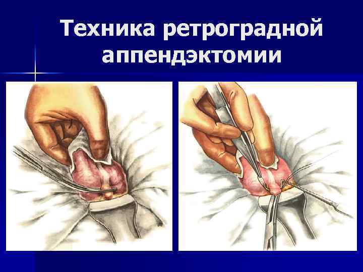 Техника ретроградной аппендэктомии 