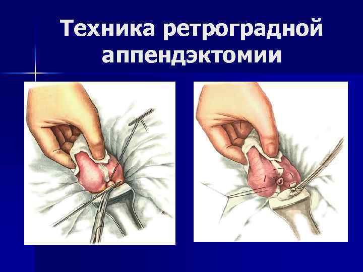 Техника ретроградной аппендэктомии 