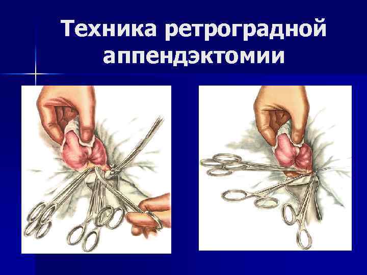 Техника ретроградной аппендэктомии 