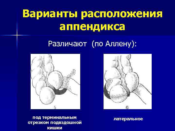 Расположение аппендикса у человека фото