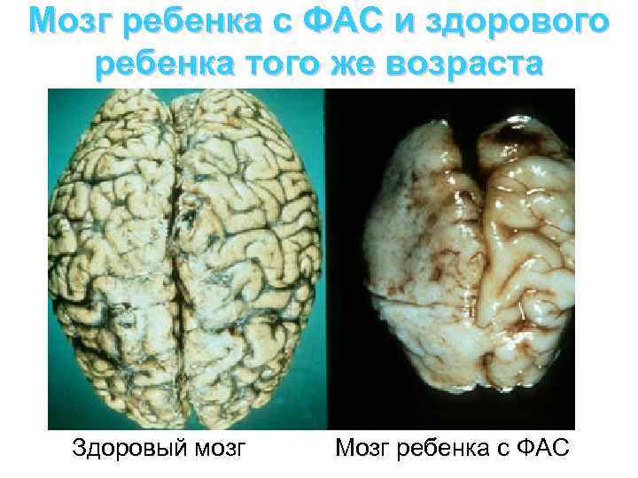 Мозг ребенка с ФАС и здорового ребенка того же возраста Здоровый мозг Мозг ребенка