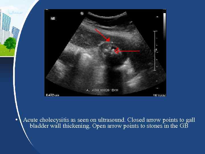  • Acute cholecysitis as seen on ultrasound. Closed arrow points to gall bladder