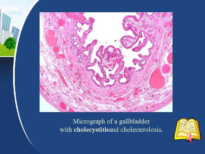 Micrograph of a gallbladder with cholecystitisand cholesterolosis. 