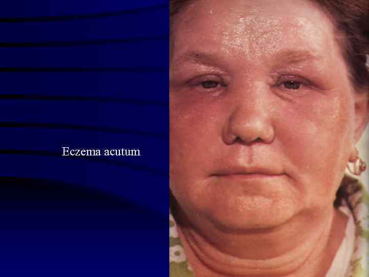 Eczema acutum 