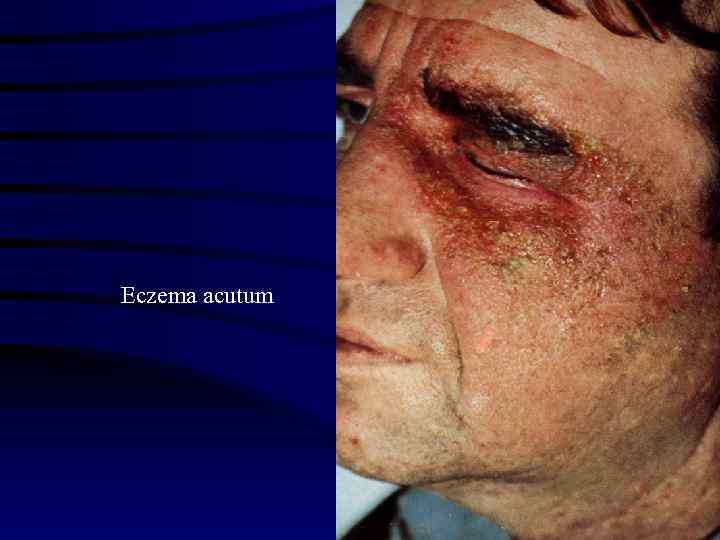 Eczema acutum 