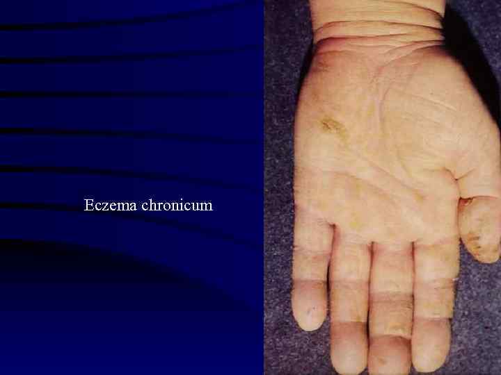 Eczema chronicum 