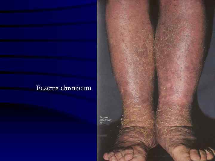 Eczema chronicum 