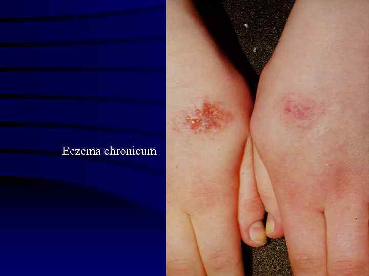 Eczema chronicum 