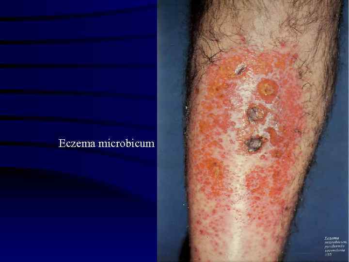 Eczema microbicum 