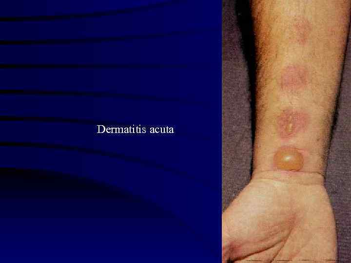 Dermatitis acuta 