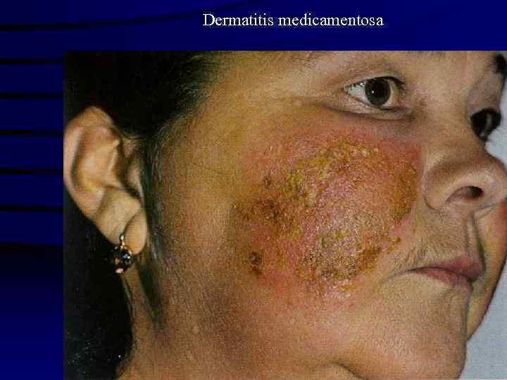 Dermatitis medicamentosa 